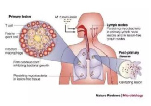 Tuberculosis