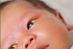 Jaundice In Newborns.png