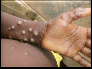 Ghana’s monkeypox cases have shot up to 34 with six regions recording cases