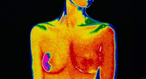 Signs of breast cancer may include a lump in the breast and a change in breast shape