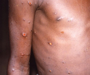 Monkeypox is a zoonotic virus