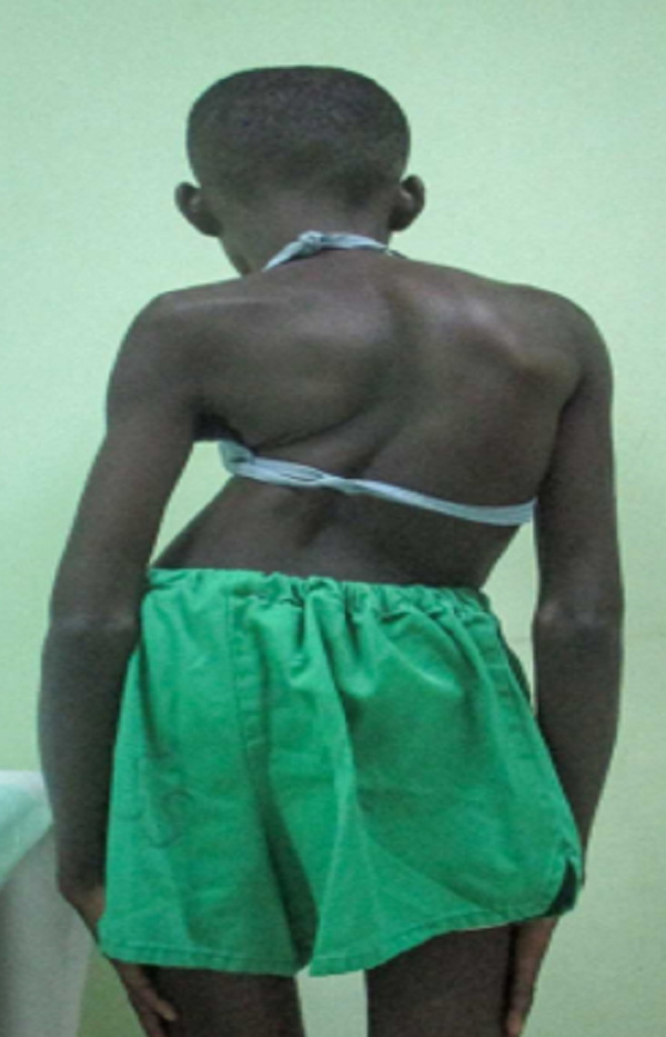 A patient suffering from a complex spinal and orthopedic condition